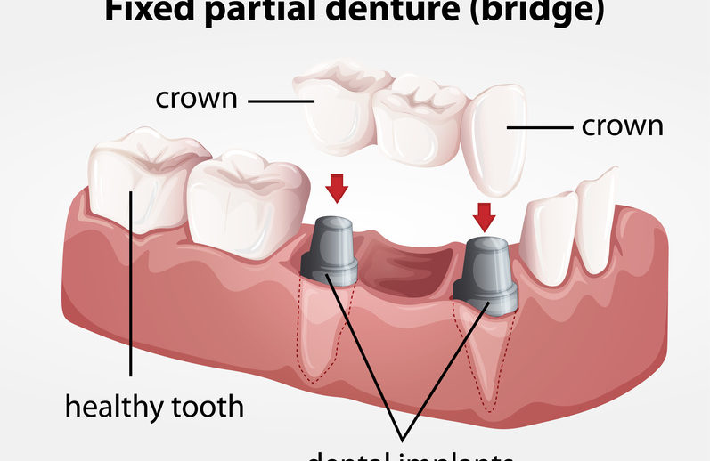 Dental bridges