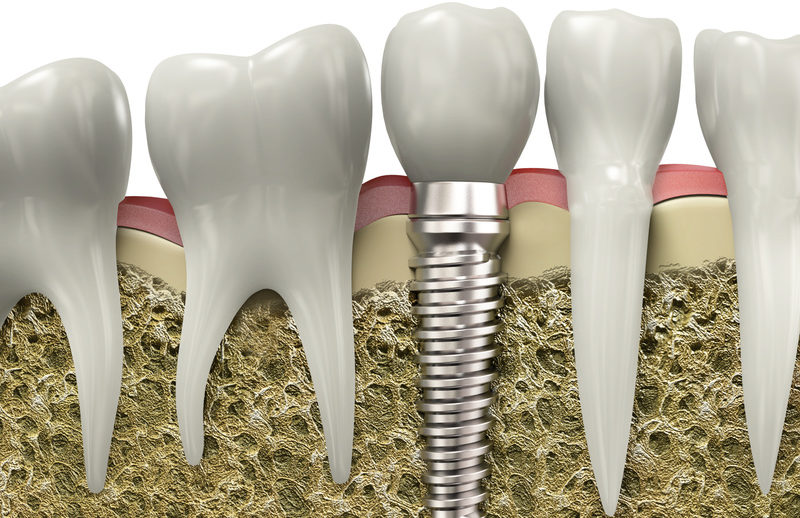 dental implants